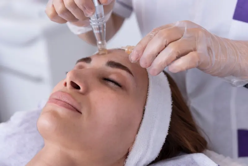 Microneedling Gesicht, Hals & Dekolleté